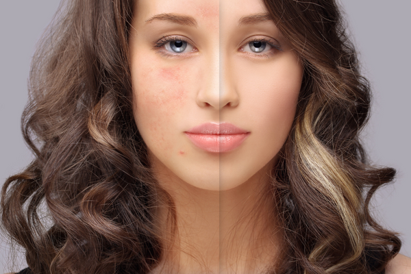 Beautiful Skin Without Chemicals: Natural Remedies for Rosacea